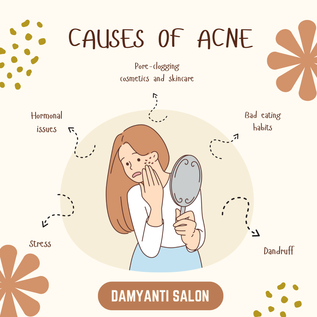 CAUSES OF ACNE